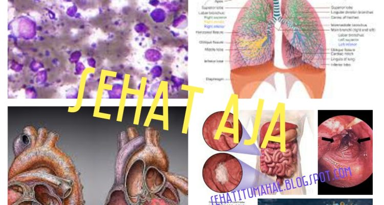 Penyakit Yang Tidak Terlihat Tetapi Berbahaya untuk Kesehatan